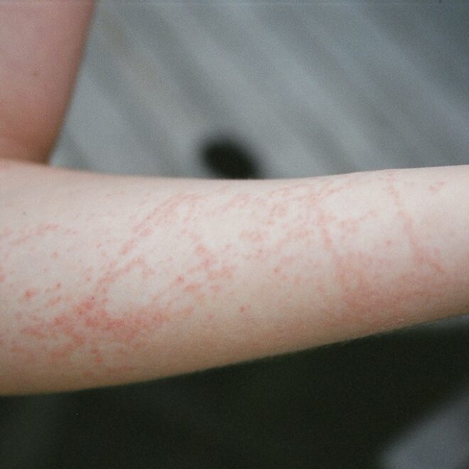 Jellyfish Sting: Symptoms, Treatment, and Prevention