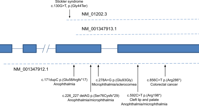 Stickler Syndrome: A Comprehensive Overview