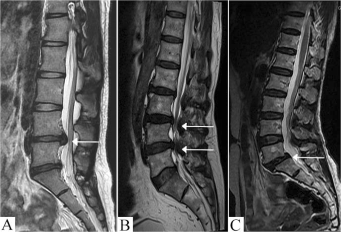 Degenerative Disc Disease: Overview, Causes, Symptoms & Care Options