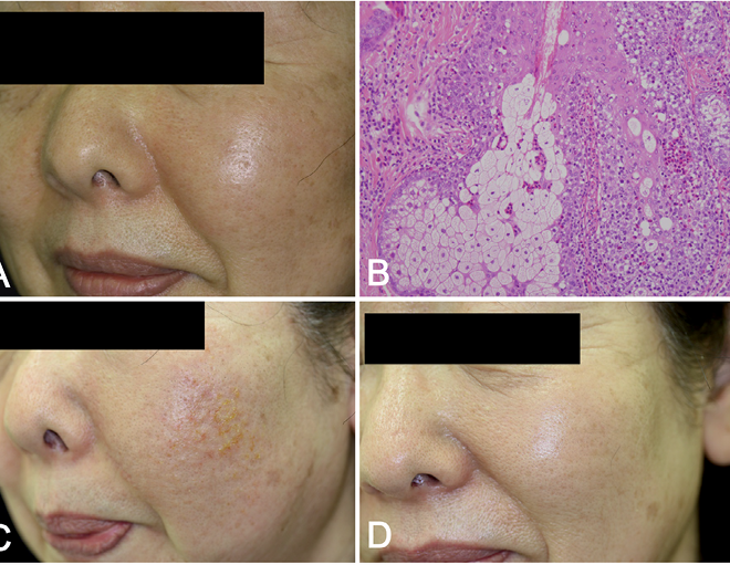 Folliculitis: Causes, Symptoms, and Treatments Explained