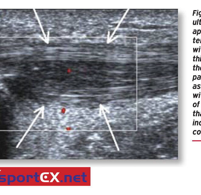 Patellar Tendinitis (Jumper’s Knee): Causes, Symptoms, and Treatments