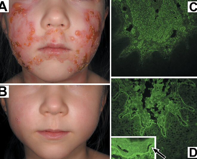 Epidermolysis Bullosa: Understanding the Rare Skin Disorder (EB)