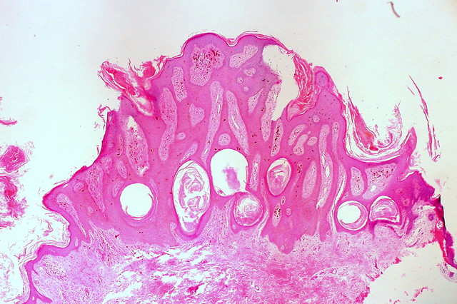 Seborrheic Keratosis: Overview, Causes, Symptoms & Removal