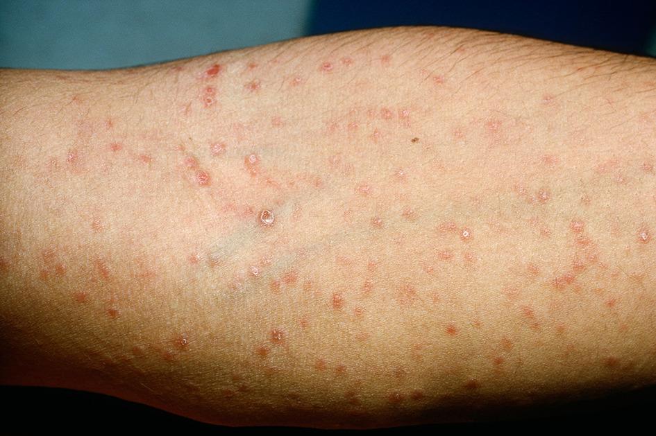 Syphilis: Understanding the Disease, Stages, Symptoms & Care
