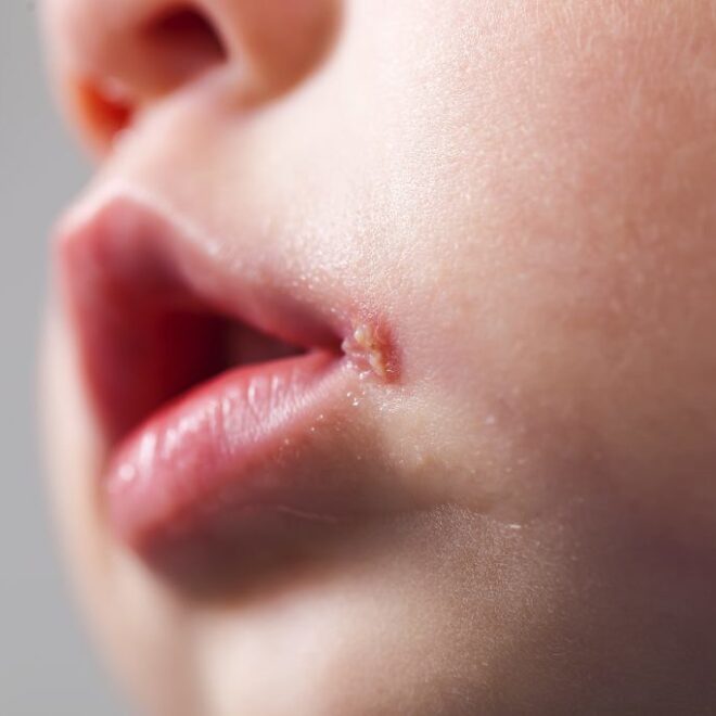 Oral Herpes (Cold Sores): Causes, Symptoms, and Treatments