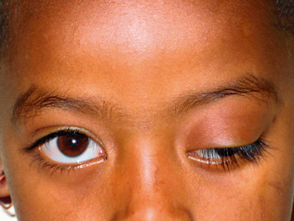Drooping Eyelid (Ptosis): Overview, Causes, Diagnosis, and Treatment Options