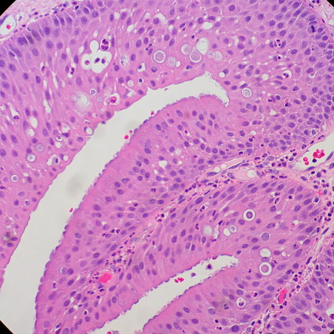 Papilloma: Types, Causes, Symptoms, and Treatments