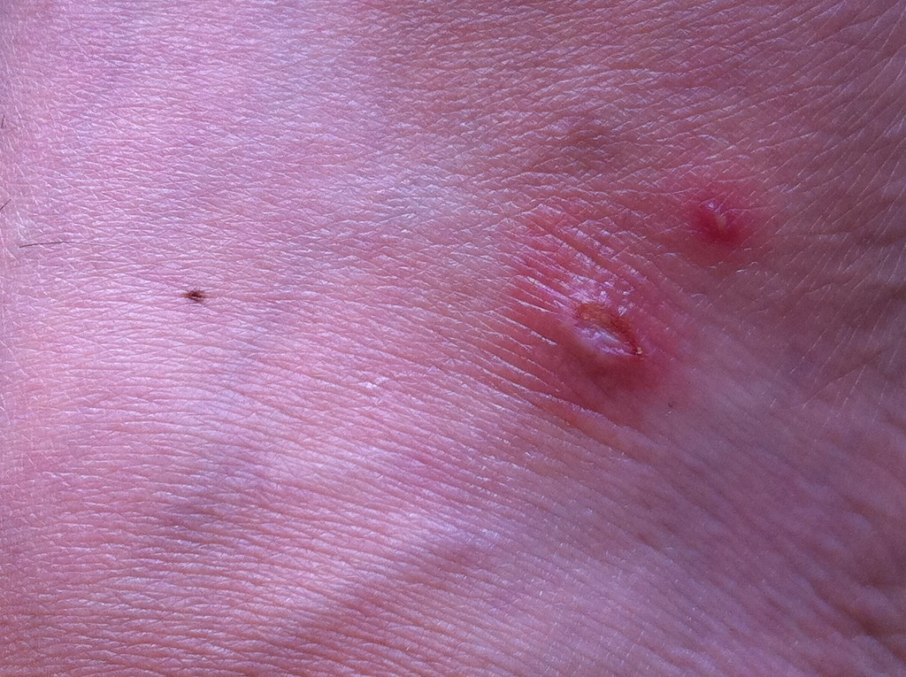 Spider Bites: Types, Symptoms, and Treatments Explained