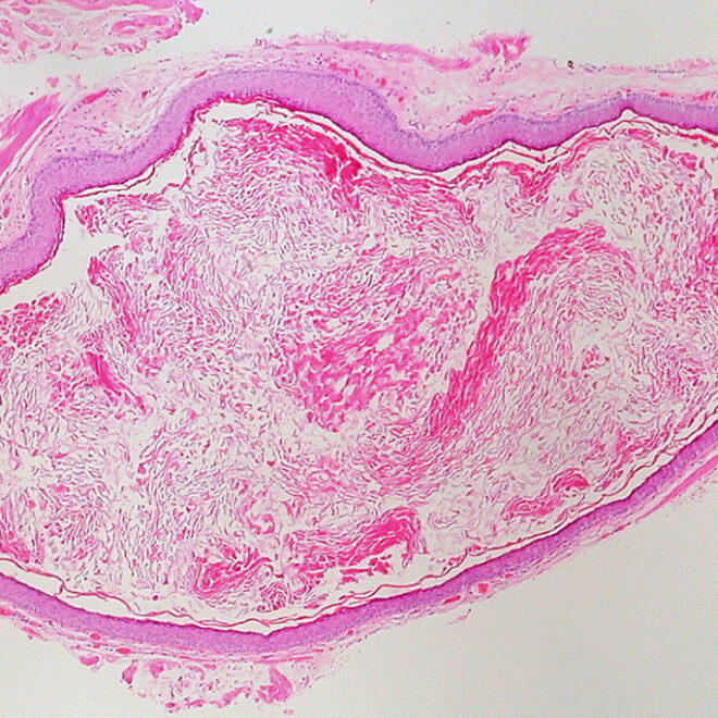 Epidermal Cyst (Sebaceous Cyst): Overview, Causes, Diagnosis, and Treatment