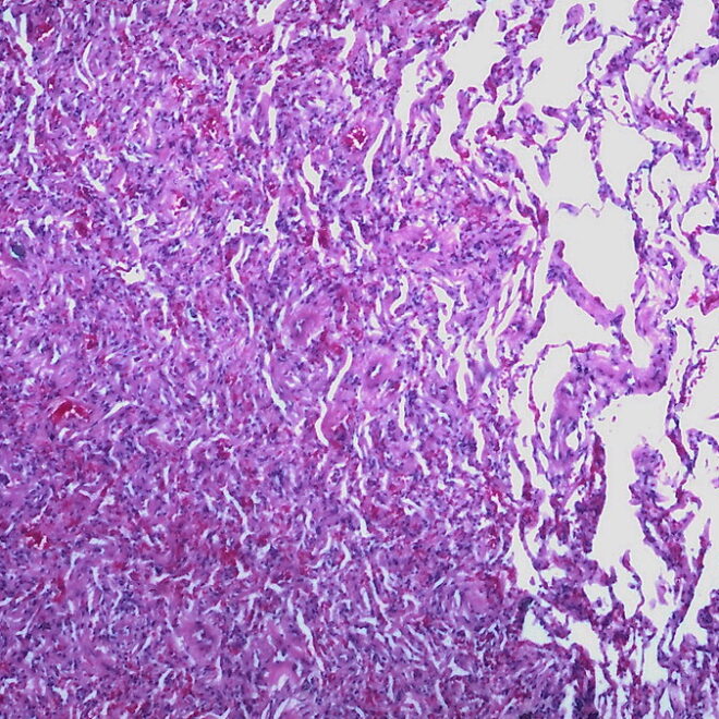 Atelectasis: Understanding Collapsed Lung, Its Types, Causes, and Treatments