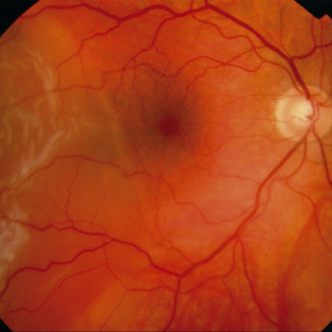 Retinal Detachment: Causes, Symptoms, Diagnosis, and Treatment