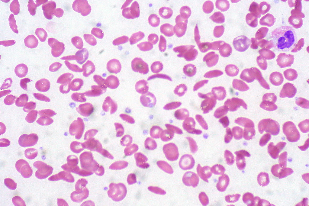 Sickle Cell Anemia: Understanding the Disease, Its Effects, and Care Options