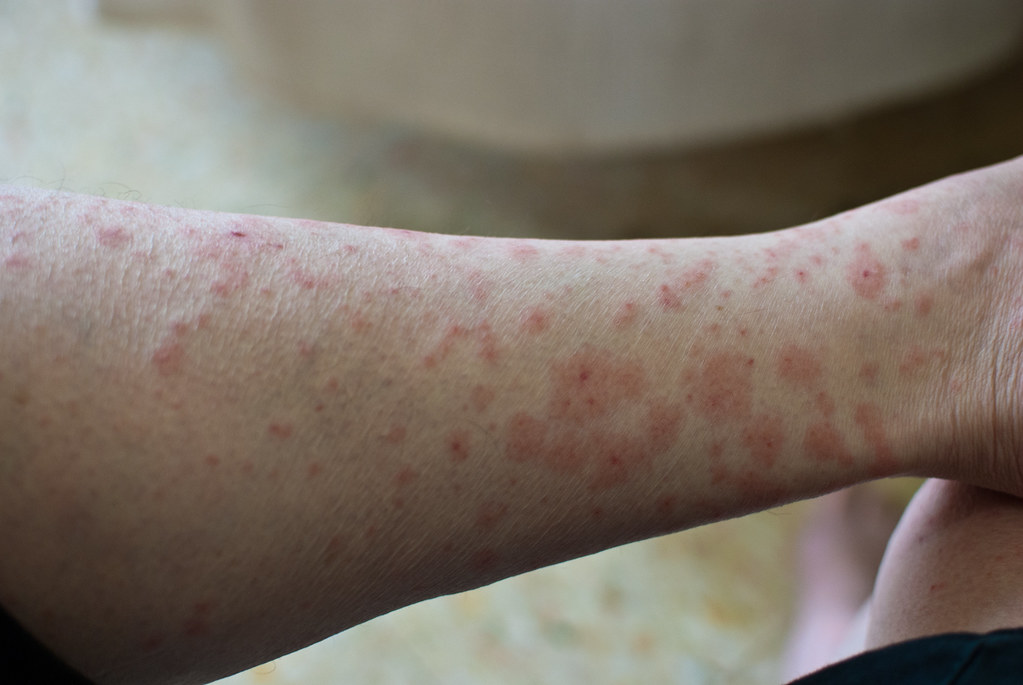 Poison Ivy Rash: Causes, Symptoms, Prevention, and Treatment