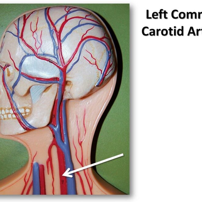 Carotid Artery Disease (Narrowing of Neck Arteries): Overview, Causes, Symptoms & Treatments
