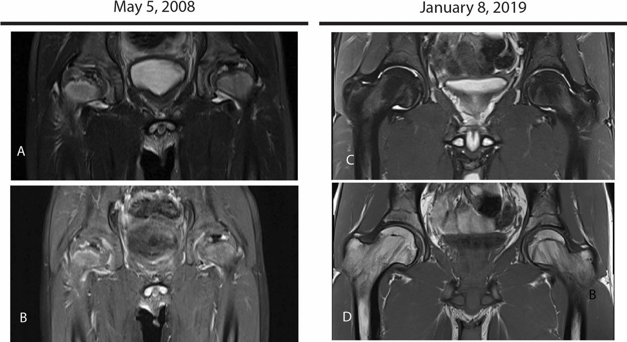 Legg-Calv'-Perthes Disease (Hip Joint Disorder): Overview, Symptoms, Diagnosis & Care