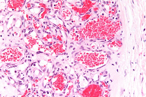 Hemangioma: A Complete Guide to Causes, Types, and Treatments