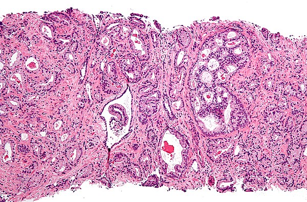 Prostate Cancer: Understanding the Disease, Diagnosis, and Treatments