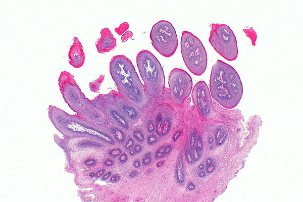 Papilloma: Types, Causes, Symptoms, and Treatments