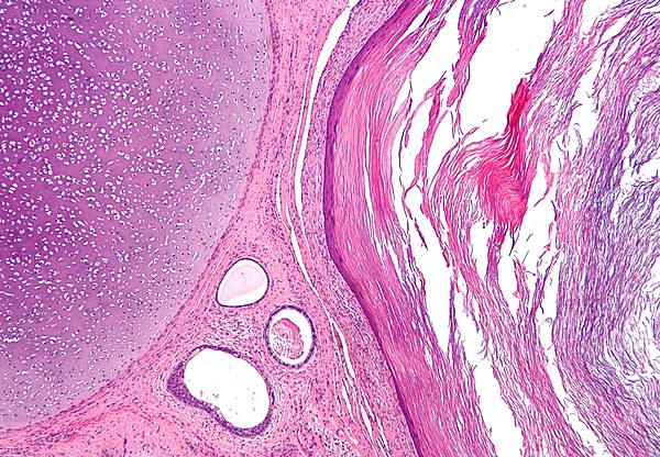 Teratoma: A Detailed Overview of the Tumor Type (Mature and Immature Teratomas)