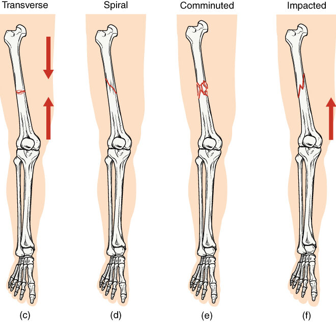 Broken Bone: Types, Causes, Healing Process & Care