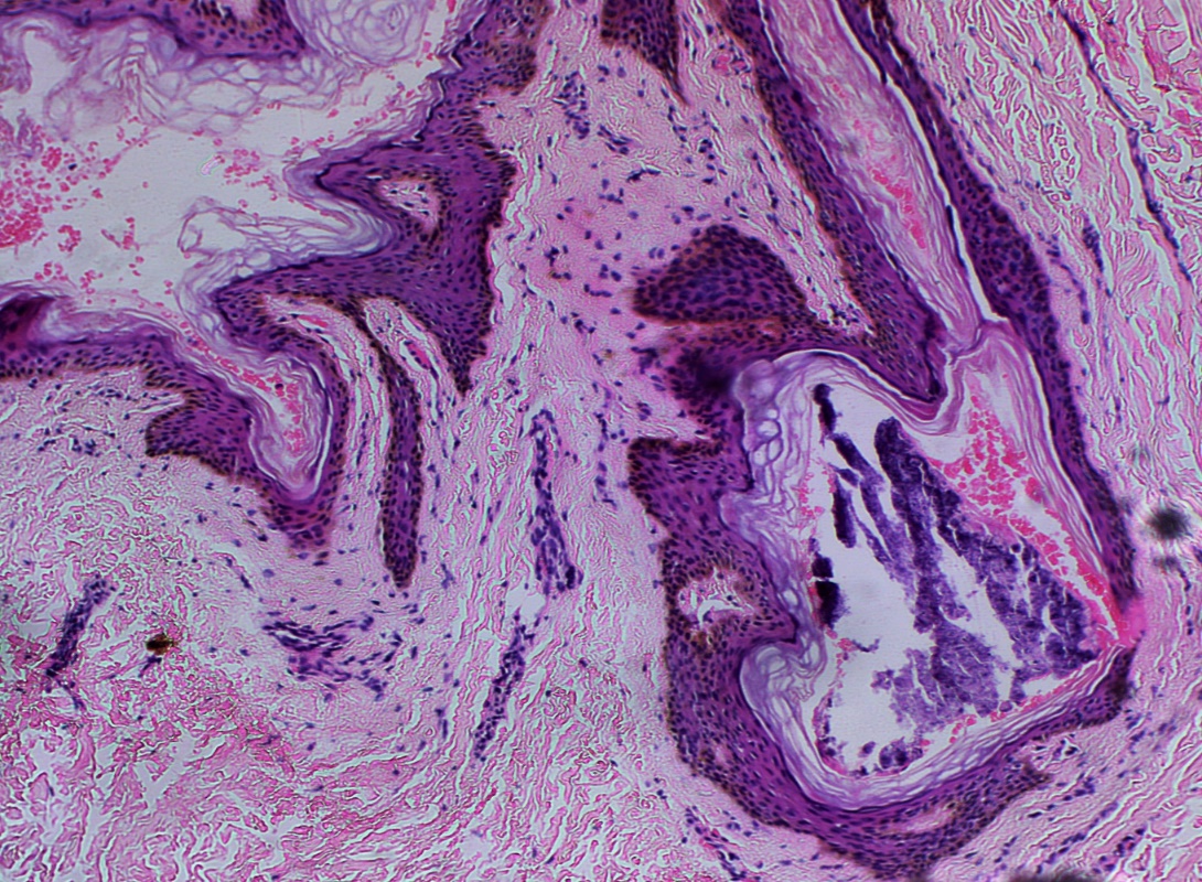 Sebaceous Cyst: Causes, Symptoms, Diagnosis, and Treatment