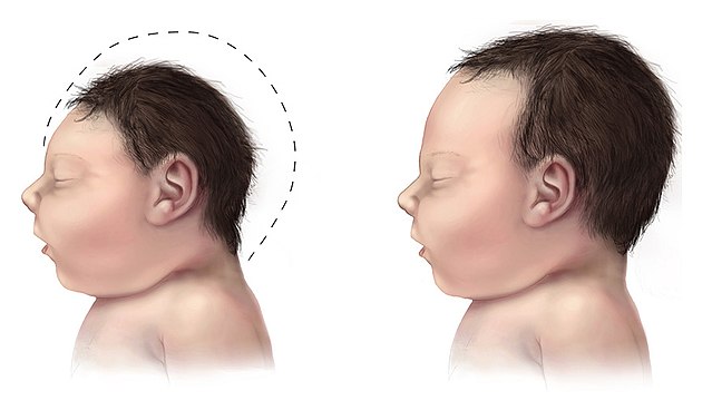 Microcephaly (Small Head Size): Causes, Symptoms, and Care Options