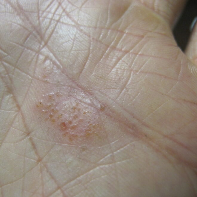 Dyshidrosis (Pompholyx): A Complete Guide to Symptoms, Triggers, and Treatments