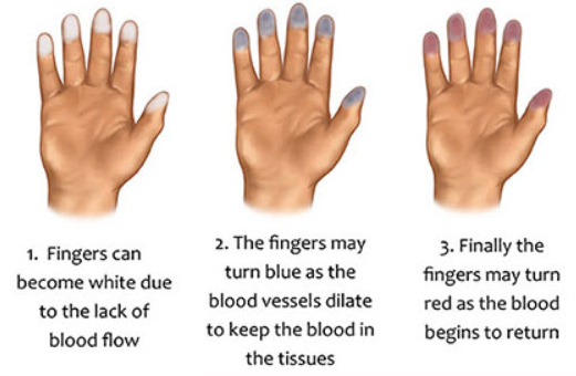 Raynaud's Phenomenon (RP): Causes, Symptoms, Diagnosis, and Treatments