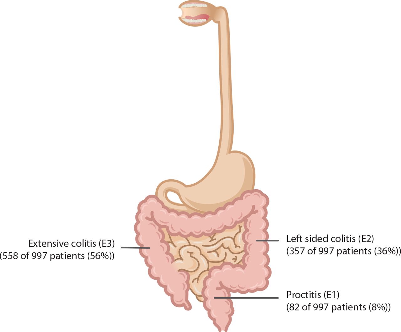 Inflammation of the Rectum (Proctitis): Causes, Symptoms, and Treatments
