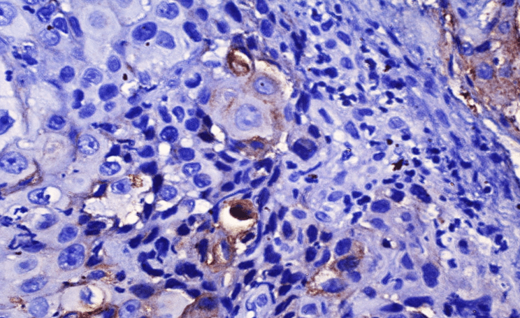 Keratoacanthoma: A Guide to Causes, Symptoms, Diagnosis, and Treatment