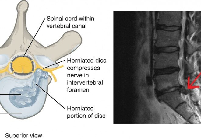 Prolapsed Disc (Slipped Disc): Overview, Causes, Symptoms & Treatments