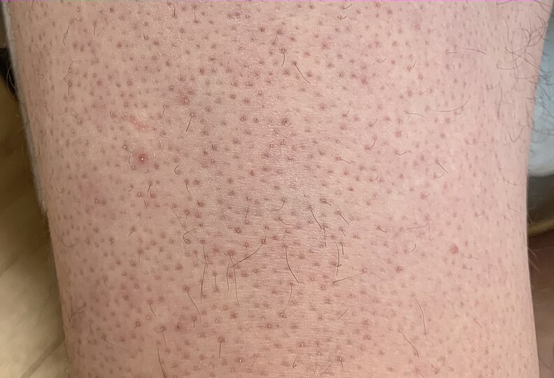 Keratosis Pilaris: What It Is, Causes, Symptoms & Treatment