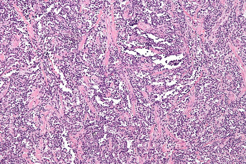 Rhabdomyosarcoma: Understanding the Rare Muscle Cancer