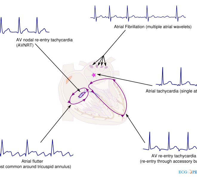 Fast Heartbeat from Above the Ventricles (SVT): Overview, Triggers, Symptoms & Care