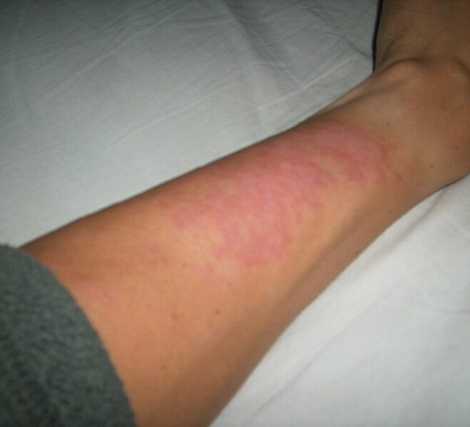 Sun Poisoning: Symptoms, Causes, Treatments, and Prevention