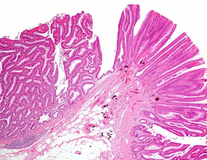 Colorectal Polyps: Types, Causes, Diagnosis, and Removal