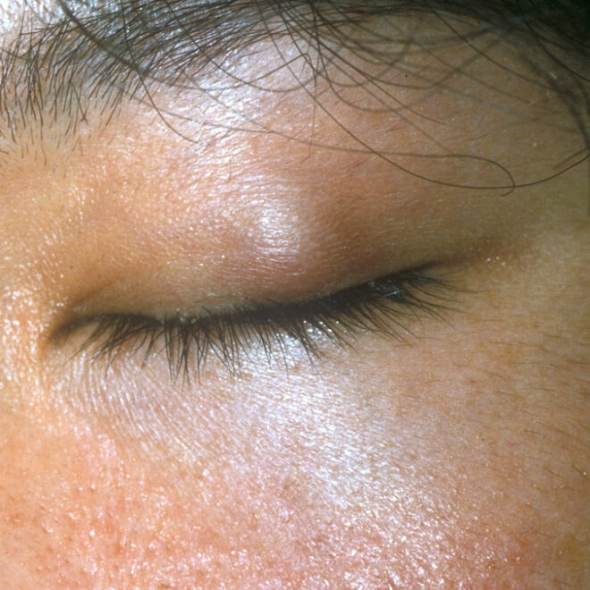 Chalazion: Causes, Symptoms, Diagnosis, and Treatment Options