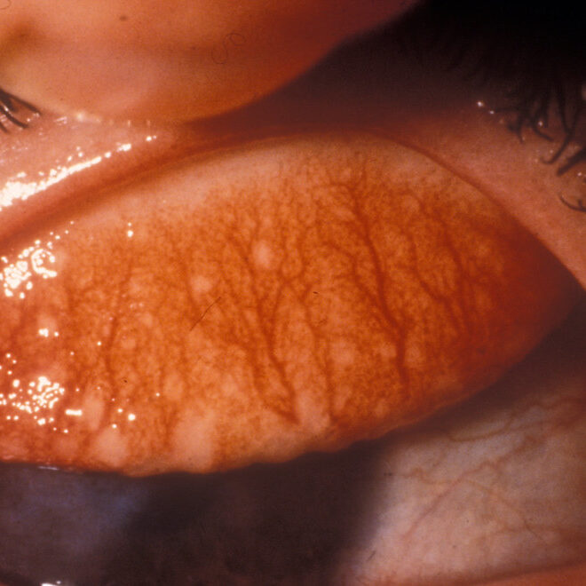 Trachoma: Causes, Symptoms, Prevention, and Treatment