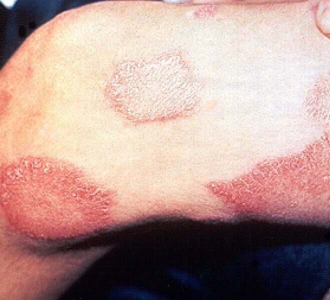 Leprosy (Hansen’s Disease): Causes, Symptoms, Diagnosis, and Treatment