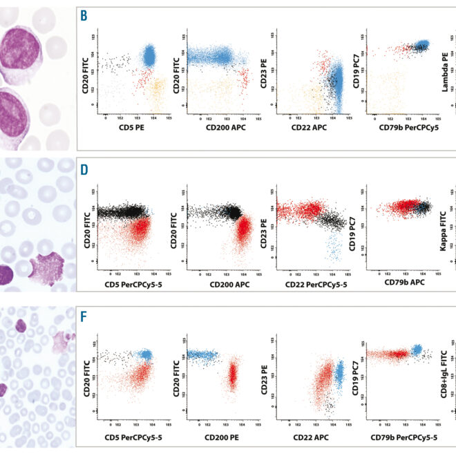 Chronic Lymphocytic Leukemia (CLL): Overview, Symptoms, Diagnosis & Care