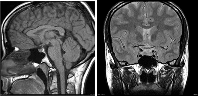 Sheehan's Syndrome: Understanding Postpartum Pituitary Gland Damage