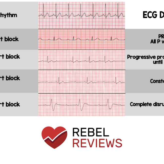 Heart Block: Understanding Its Types, Causes, and Treatments