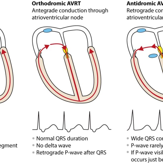 Fast Heart Rate (Tachycardia): Overview, Types, Causes & Treatments