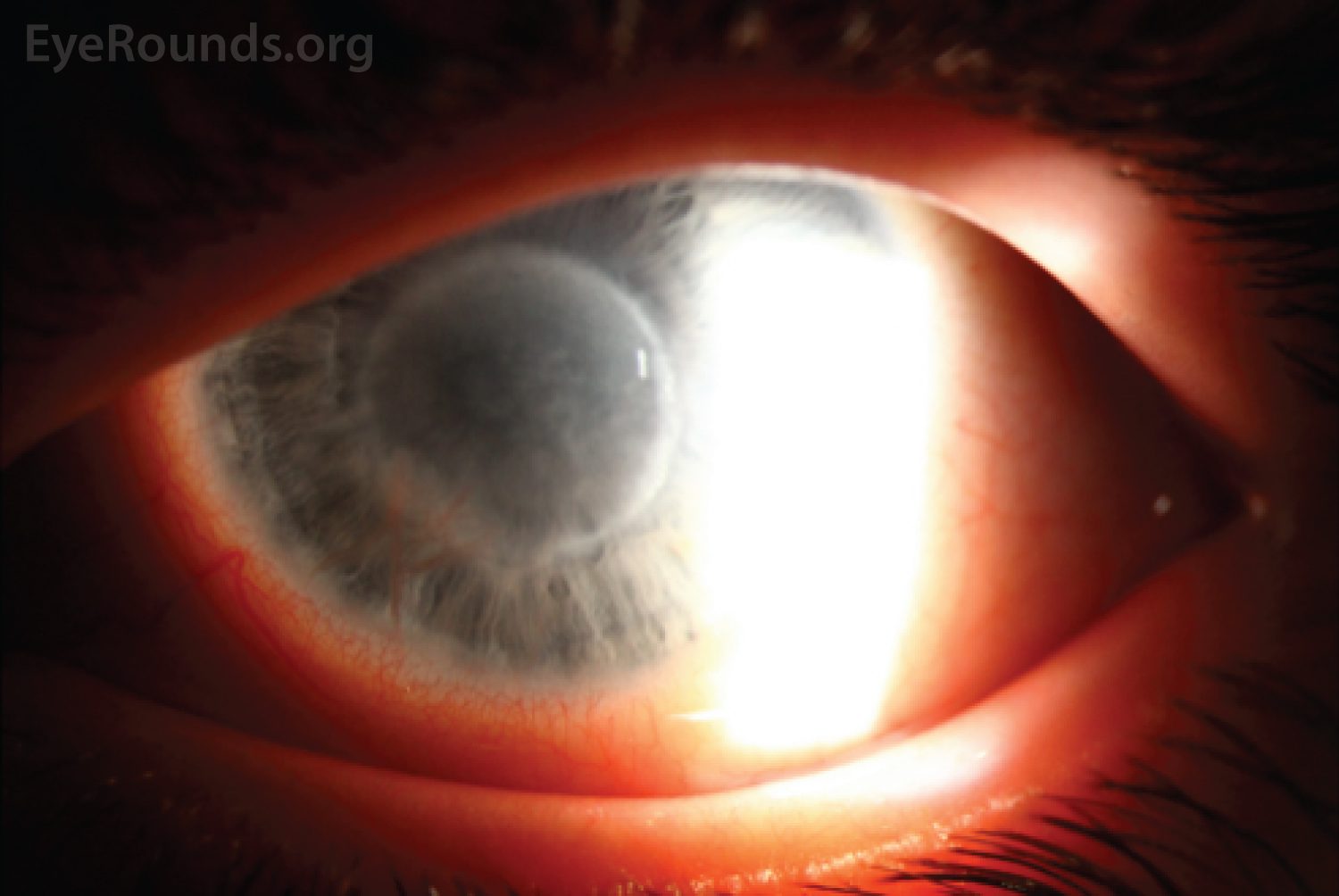 Keratitis: Causes, Symptoms, Diagnosis, and Treatment Options