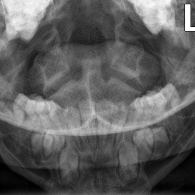 Achondroplasia: A Detailed Overview of the Most Common Form of Dwarfism (ACH)