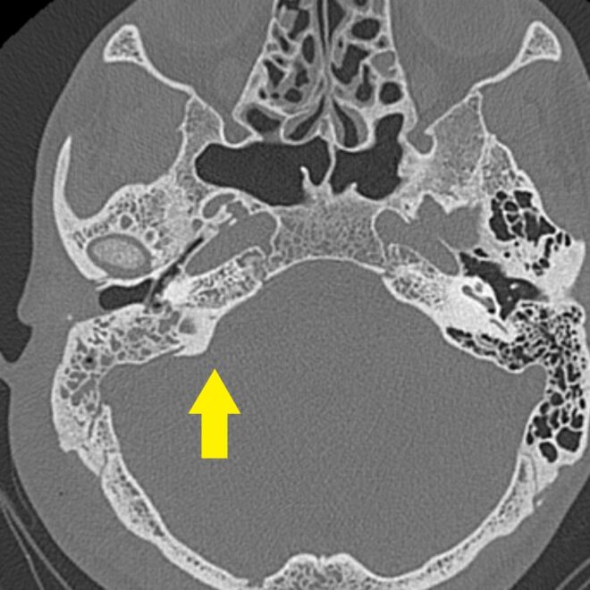 Mastoiditis (Ear Bone Infection): Causes, Symptoms & Treatments