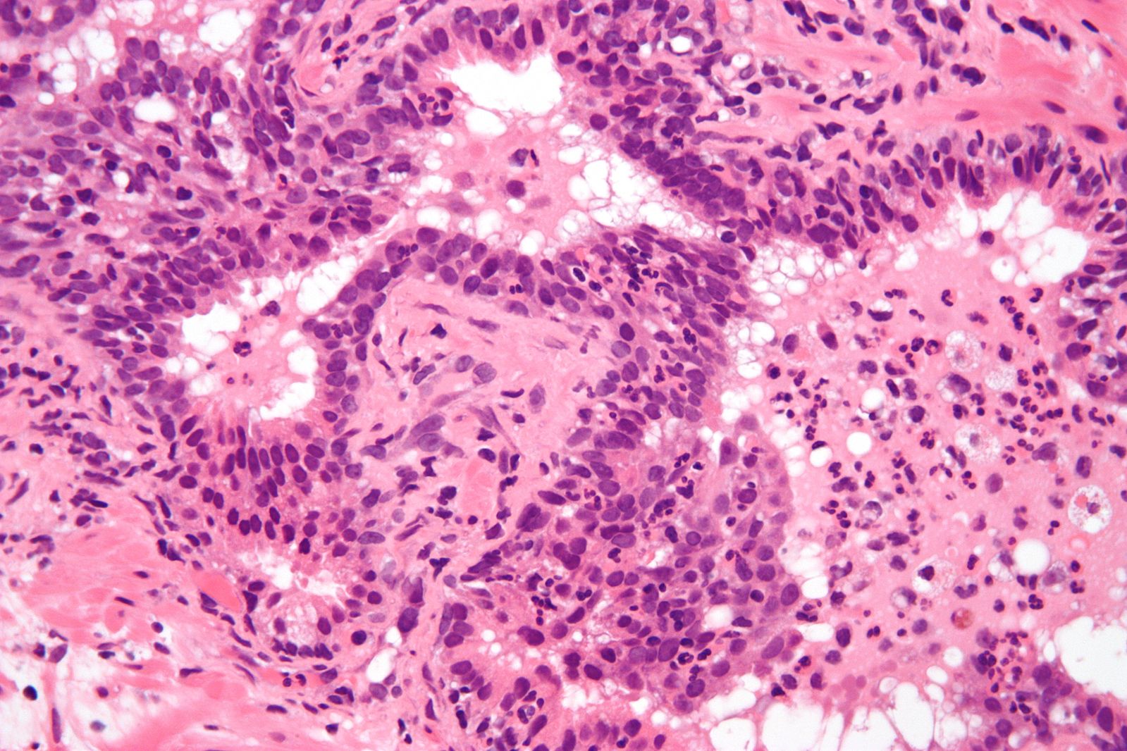 Prostatitis: Causes, Symptoms, Diagnosis, and Treatment Options