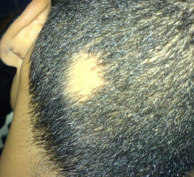 Alopecia Areata: Understanding Hair Loss Patches, Causes, and Treatments