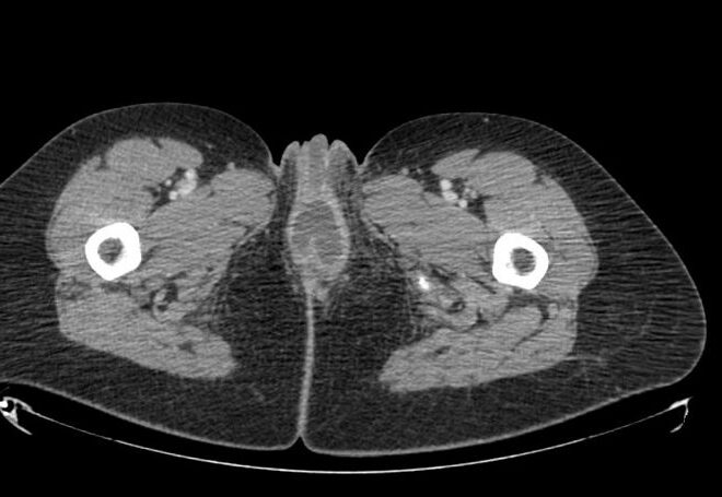 Bartholin’s Cyst: Overview, Causes, Symptoms, and Treatments
