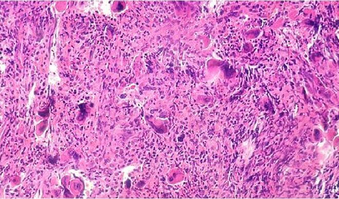 Myelofibrosis: Understanding Bone Marrow Scarring and Its Effects